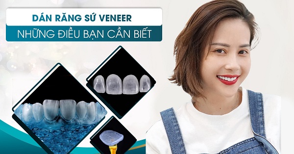 Những điều cần biết phương pháp dán sứ Veneer.