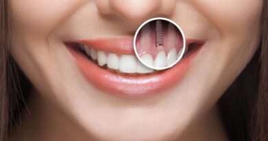 Chọn trụ Implant chất lượng