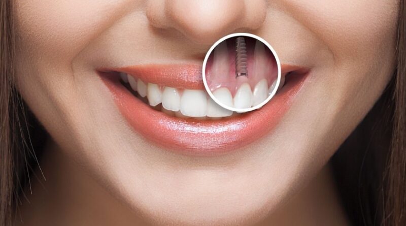 Chọn trụ Implant chất lượng