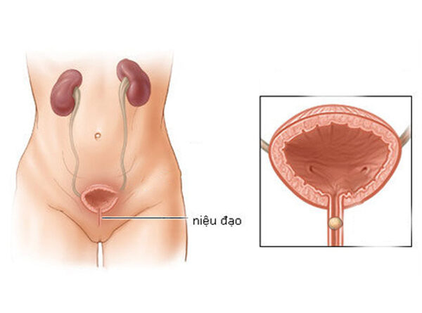 Sỏi niệu đạo: Nguyên nhân, triệu chứng và cách phòng ngừa