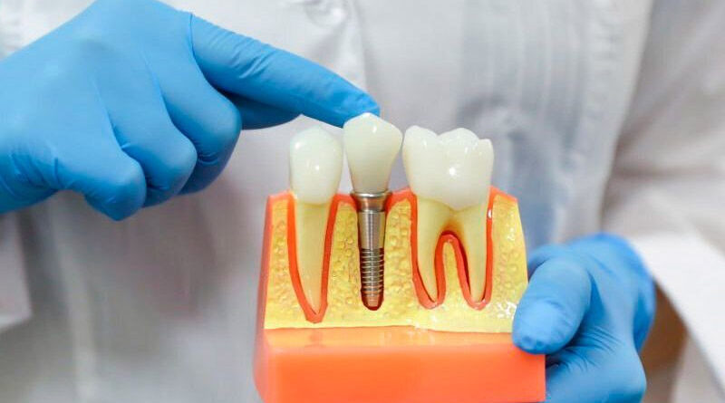 Ưu điểm của cấy răng Implant