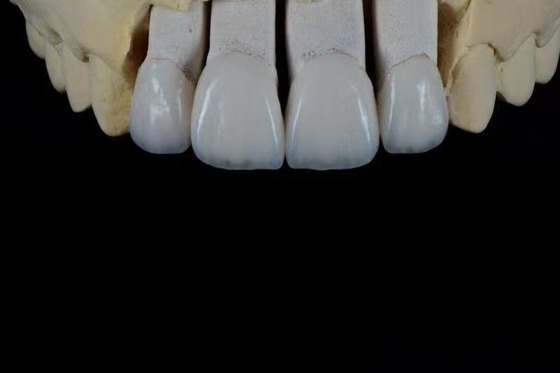 Sứ Feldspathic