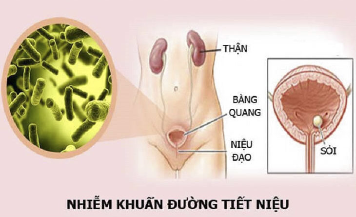 Viêm đường tiết niệu