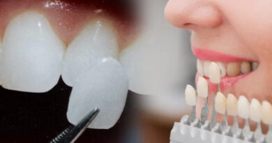 Những lưu ý khi dán sứ Veneer