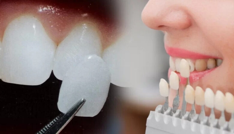 Những lưu ý khi dán sứ Veneer